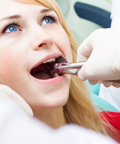 how long should you wait to exercise after tooth extraction
