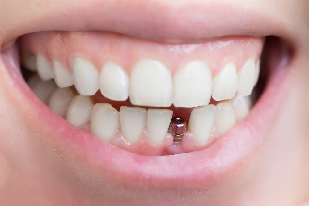 How Dental Implants Prevent Premature Ageing and Facial Collapse